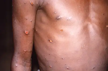 Brasil supera marca de mil casos de mpox em 2024