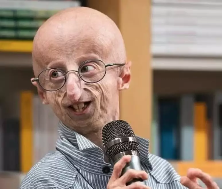 Progeria, a doença do envelhecimento precoce, tem cura? Conheça o quadro