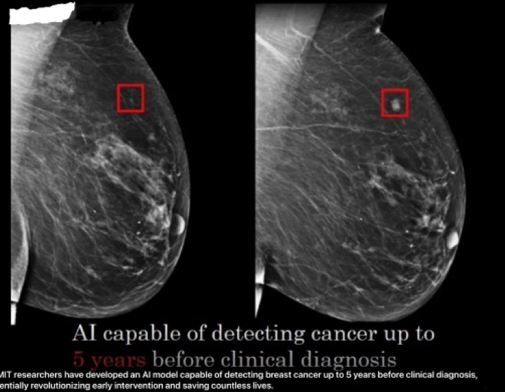 Pesquisadores de Massachusetts desenvolvem estudo que prever câncer de mama até 5 anos antes do diagnóstico